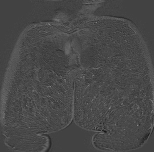Figure 5 for case Silicon granuloma gluteal augmentation
